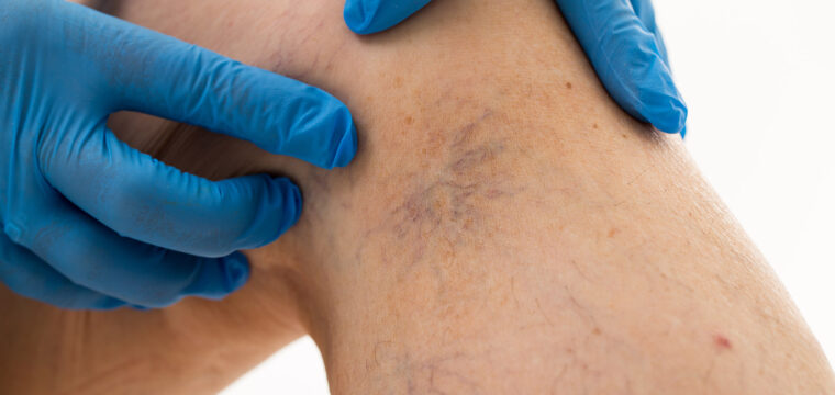 spider veins