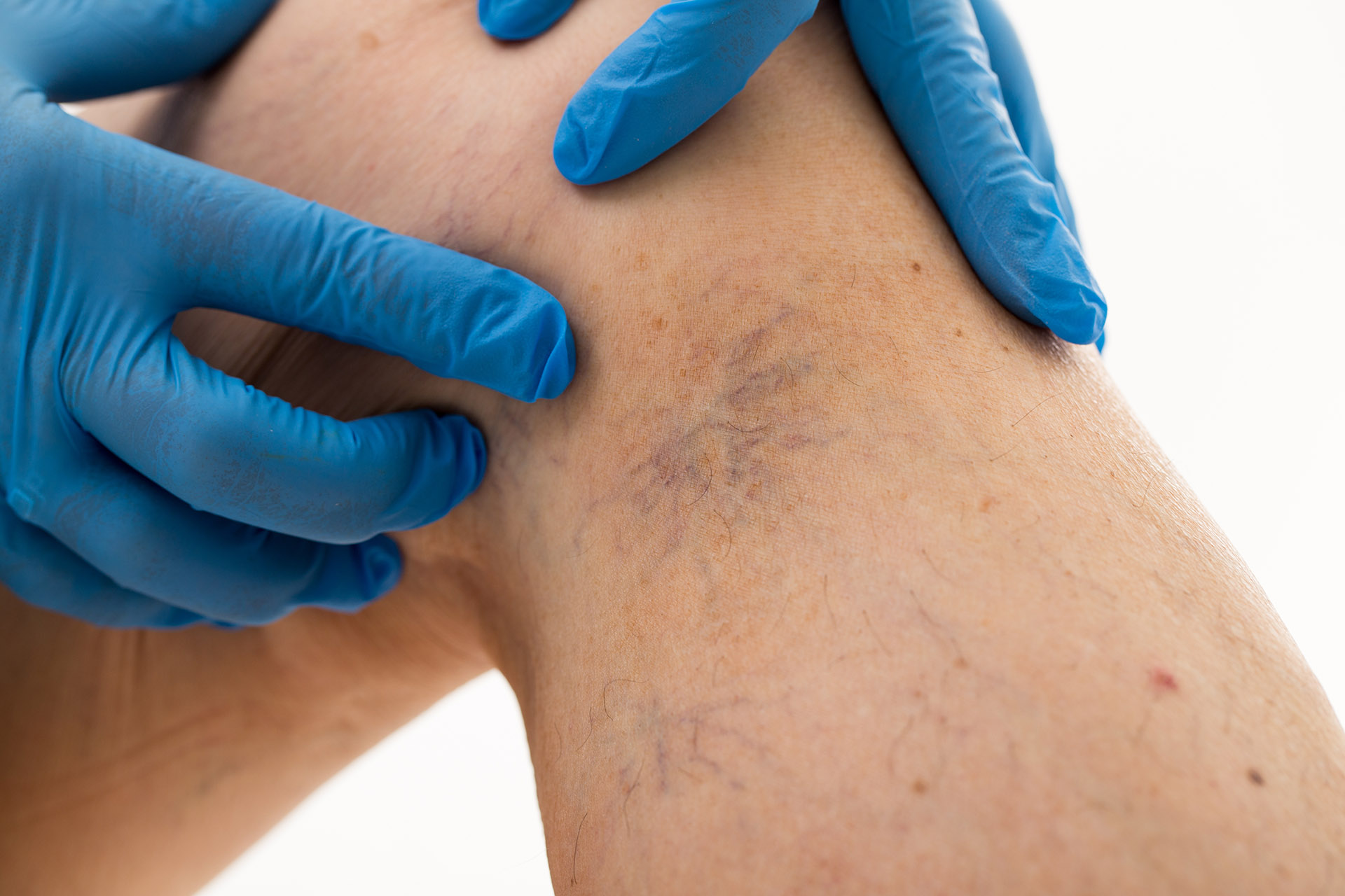 Are Spider Veins a Health Concern? - Vein Health Clinics