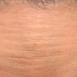 anti wrinkle injections before after