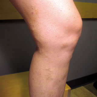 varicose-vein before after