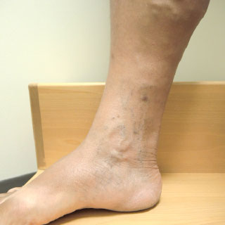 varicose-vein before after