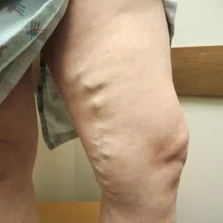 varicose-vein before after varicose-vein before after