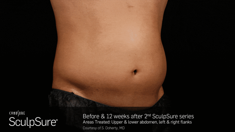BA_Animated_SculpSure_Doherty_Core_2Tx_12Weeks_01_16.03_compressed-min