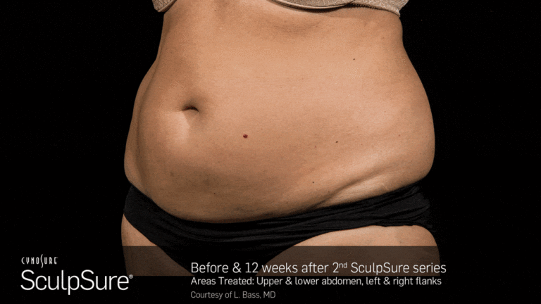 BA_Animated_SculpSure_L.Bass_Core_2tx_12wks_01_17_compressed-min
