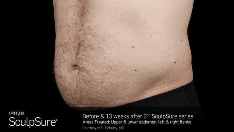 BA_Animated_SculpSure_S.Doherty_Core_2tx_13wks_04_compressed-min