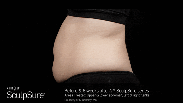 BA_Animated_SculpSure_S.Doherty_Core_2tx_6wks_10_compressed-min