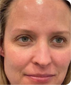 Skin Resurfacing