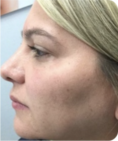 Skin Resurfacing