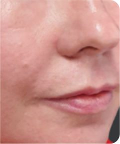 Skin Resurfacing