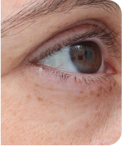 Skin Tightening