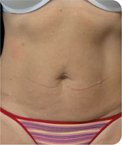 emsculpt
