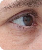 Skin Tightening