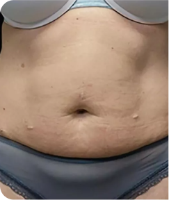 emsculpt