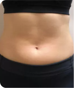emsculpt