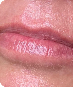 Anti-Wrinkle & Dermal Fillers
