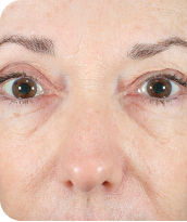 Skin Tightening
