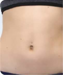 emsculpt