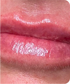 Anti-Wrinkle & Dermal Fillers