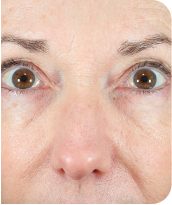 Skin Tightening