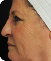 Skin Tightening