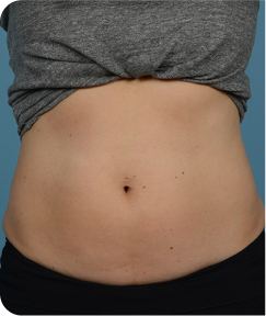 emsculpt