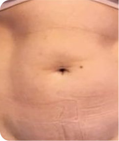 emsculpt