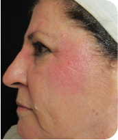 Skin Tightening