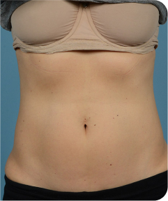 emsculpt