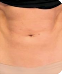 emsculpt
