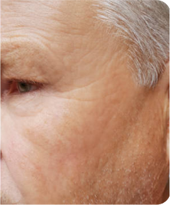 Anti-Wrinkle & Dermal Fillers