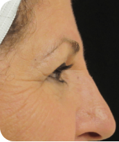Skin Tightening
