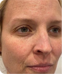 Skin Resurfacing