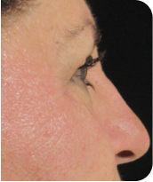 Skin Tightening