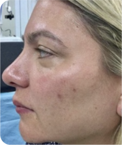 Skin Resurfacing