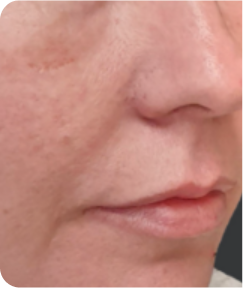 Skin Resurfacing