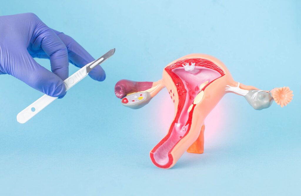 treatment of fibroids